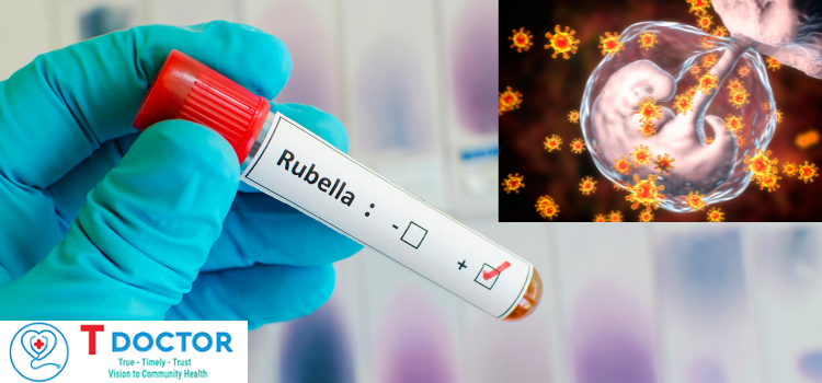 Trẻ mắc hội chứng Rubella bẩm sinh 